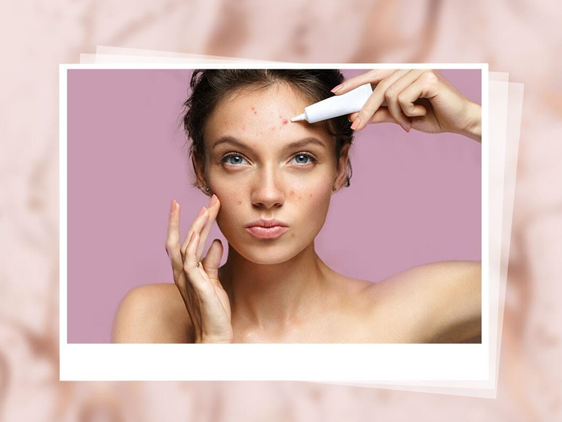 5 Tips For Skin Care For Acne-Prone Skin